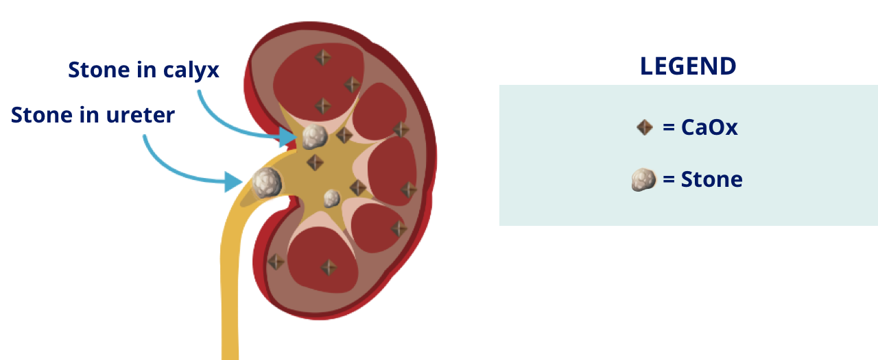 How kidney and bladder stones form