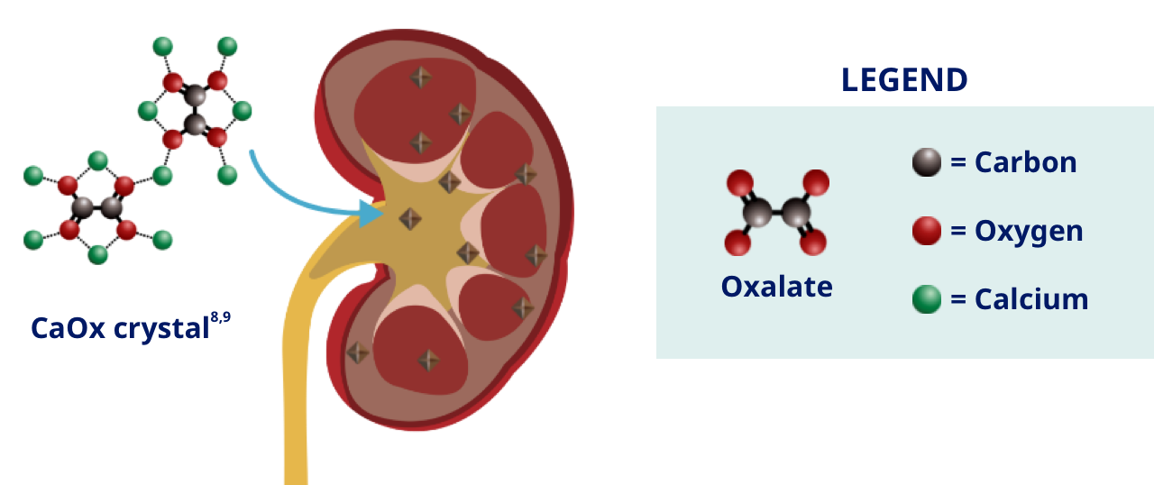 How kidney and bladder stones form